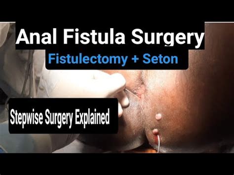 Dans presque tous les cas, une opération est nécessaire. . Fistula anale ne shqip